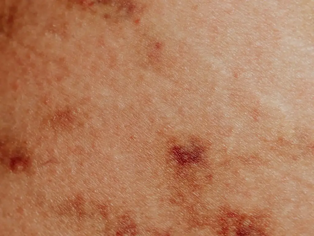 Psoriasis Scalp Care