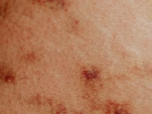 Psoriasis Scalp Care